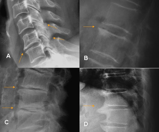 Los ejercicios físicos a la osteocondrosis sheynogo de la columna vertebral